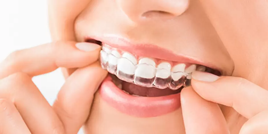 マウスピース矯正のイメージ