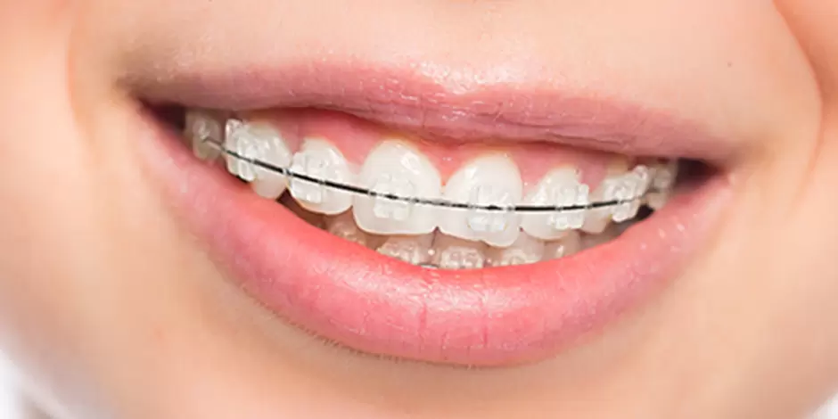 ワイヤー矯正のイメージ