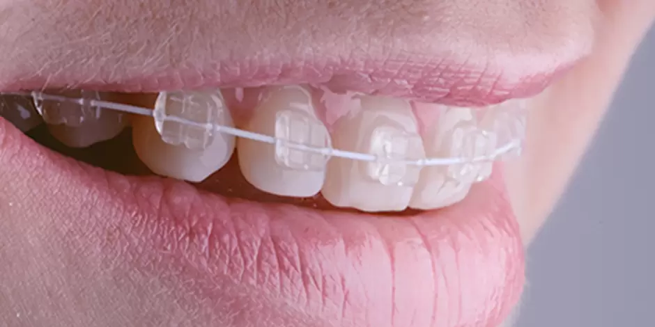 審美ブラケットのイメージ