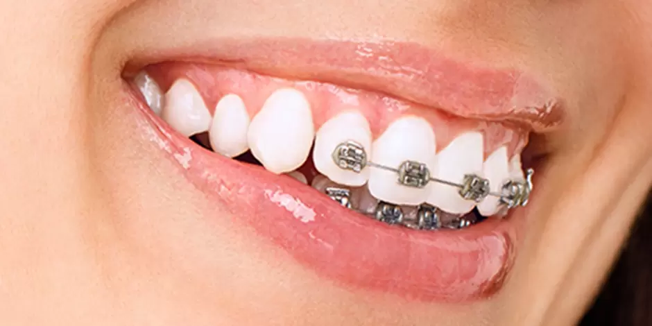 部分矯正のイメージ